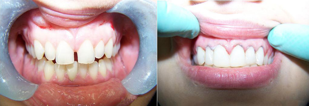 beforeafter-ev